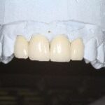 Dental crowns