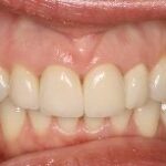 Dental crowns