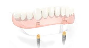 Anchoring Anchoring dentures | Dental Implant | Northumberland Dental Care