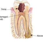 Endodontics Procedure - Step 1