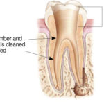 Endodontics Procedure - Step 2