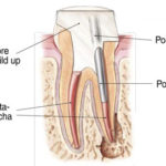 Endodontics Procedure - Step 5