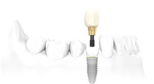Single Single Implant | Dental Implant | Northumberland Dental Care