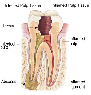 Root Canal - Endodontics - Northumberland Dental Care