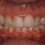 Dental crowns