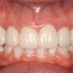 Dental crowns