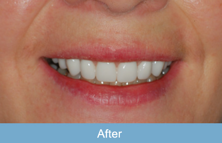 Dental implant after 1. Dental implant after 1