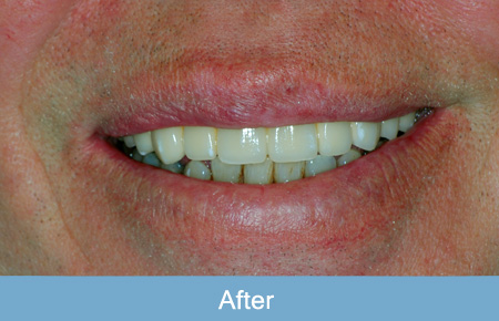 Dental implant after 2. Dental implant after 2