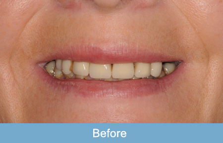 Dental implant before 1. Dental implant before 1