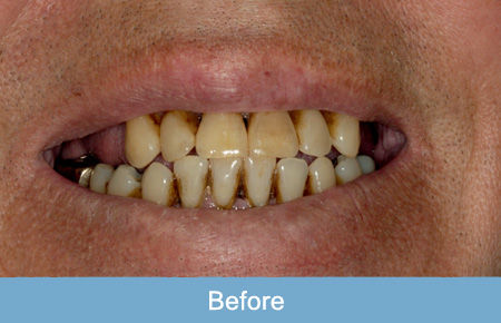 Dental implant before 2. Dental implant before 2