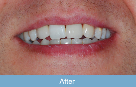 Dental implants after 3. Dental implants after 3