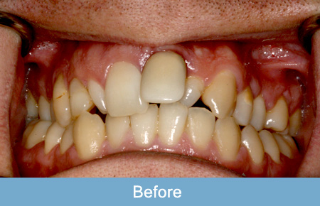 Dental implants before 3. Dental implants before 3