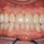 Dental crowns