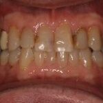Dental crowns