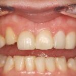 Dental crowns