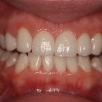 Dental crowns