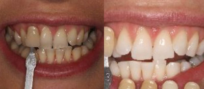 KoR Teeth Whitening Before & Afters