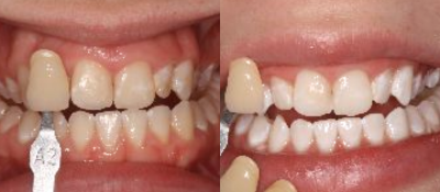 KoR Teeth Whitening Before & Afters 2