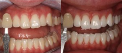 KoR Teeth Whitening Before & Afters 3