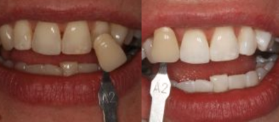 KoR Teeth Whitening Before & Afters