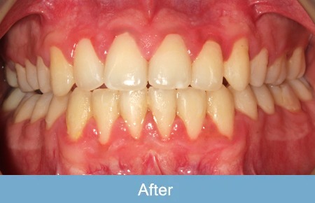Orthodontics, After 1 Orthodontics, After 1