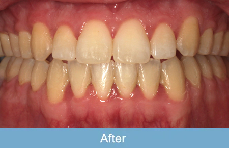 Orthodontics, After 2 Orthodontics, After 2