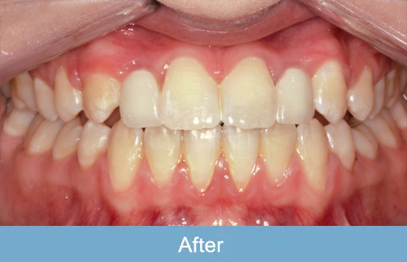 Orthodontics, After 3 Orthodontics, After 3