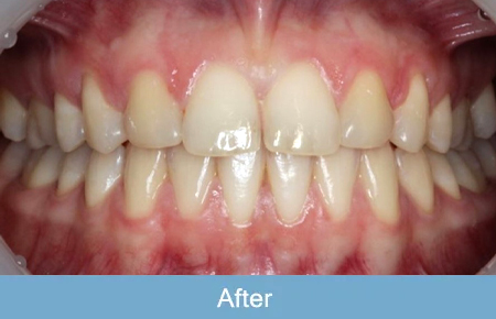 Orthodontics, After 4 Orthodontics, After 4