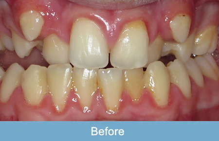 Orthodontics, Before 1 Orthodontics, Before 1