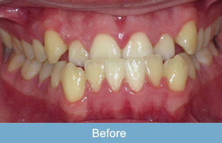 Orthodontics, Before 2 Orthodontics, Before 2
