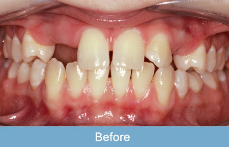 Orthodontics, Before 3 Orthodontics, Before 3