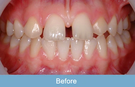 Orthodontics, Before 4 Orthodontics, Before 4