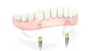 Anchoring dentures | Dental Implant | Northumberland Dental Care