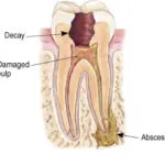 Endodontics Procedure - Step 1