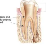 Endodontics Procedure - Step 2