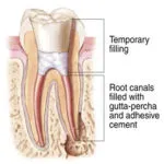 Endodontics Procedure - Step 3