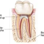 Endodontics Procedure - Step 4