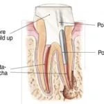 Endodontics Procedure - Step 5