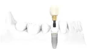 Single Implant | Dental Implant | Northumberland Dental Care