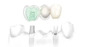 Support dentures | Dental Implant | Northumberland Dental Care
