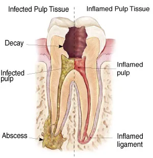 Root Canal - Endodontics - Northumberland Dental Care