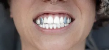 dental fashion trends