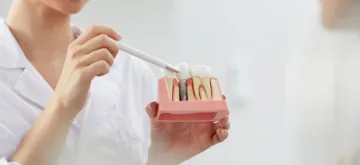 dental implants