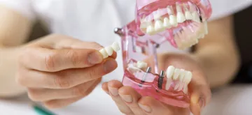 dental implants