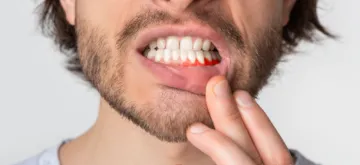 receding gums