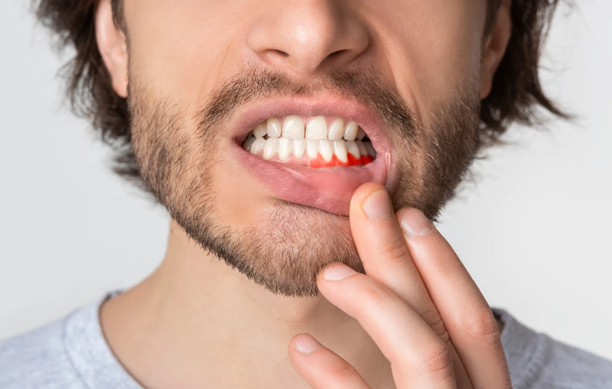 receding gums
