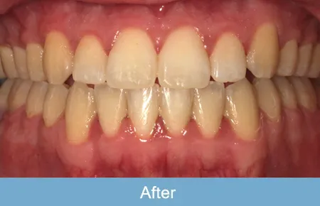 Orthodontics, After 2