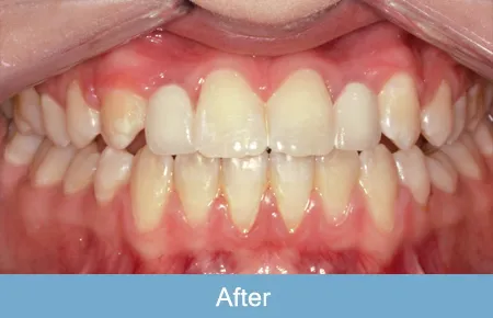 Orthodontics, After 3