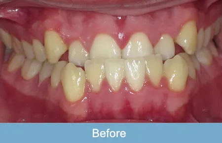 Orthodontics, Before 2