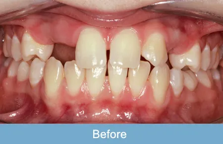 Orthodontics, Before 3